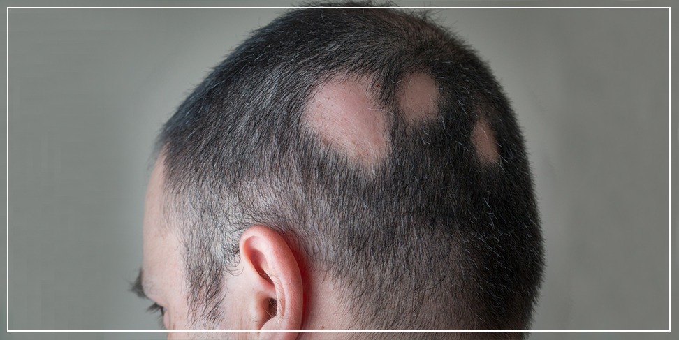 alopecia - helikobakter
